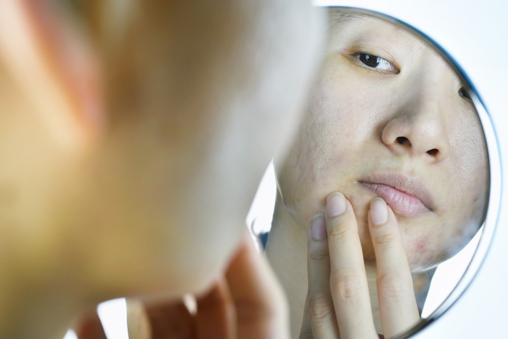 Skin,Problems,And,Acne,Scar,,Woman,Looking,At,Mirror,Worried