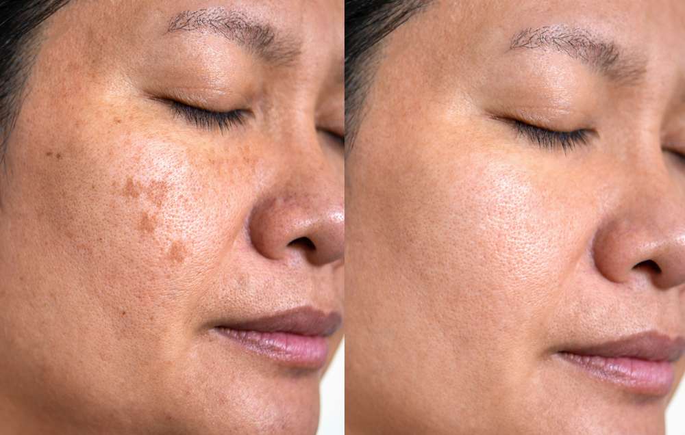 Image,Before,And,After,Spot,Melasma,Pigmentation,Facial,Treatment,On
